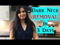 கழுத்தில் உள்ள கருமையை நீக்க/ Best Home Remedy/ Get Rid of Dark Neck -Tamil/ Chennai Girl In London
