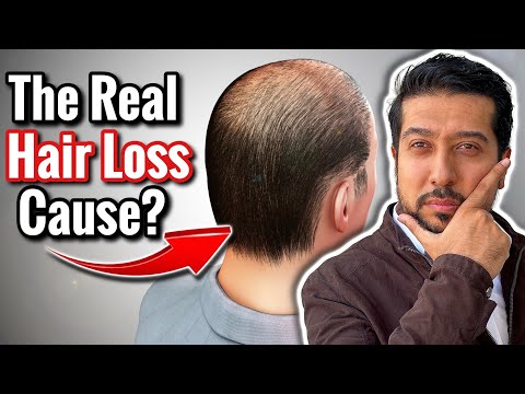 13 Vitamin Deficiencies That Cause Hair Loss