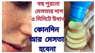 মেছতা দুর /বহু বছরের পুরনো মেছতার দাগ ৫ মিনিটে উধাও /How to get rid of pigmentation rapidly