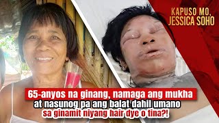 Ginang, nasunog ang balat dahil umano sa ginamit niyang hair dye o tina?! | Kapuso Mo, Jessica Soho