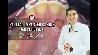 open eruption of palatal impacted canine and perio pack