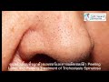 สิวเสี้ยนหัวดำดูแลอย่างไร blackhead on nose trichostasis spinulosa หมอรุจชวนคุย รักษาสิวเสี้ยน