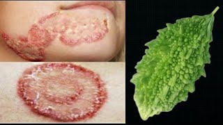 दाद खाज खुजली कितने भी साल पुरानी हो 2 दिन में छुट्टी कर देगा ये उपाय Fungal Infection Treatment