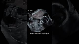 Ultrasound report Baby Boy or Girl? 12 weeks Gender Reveal 🤗 #shorts