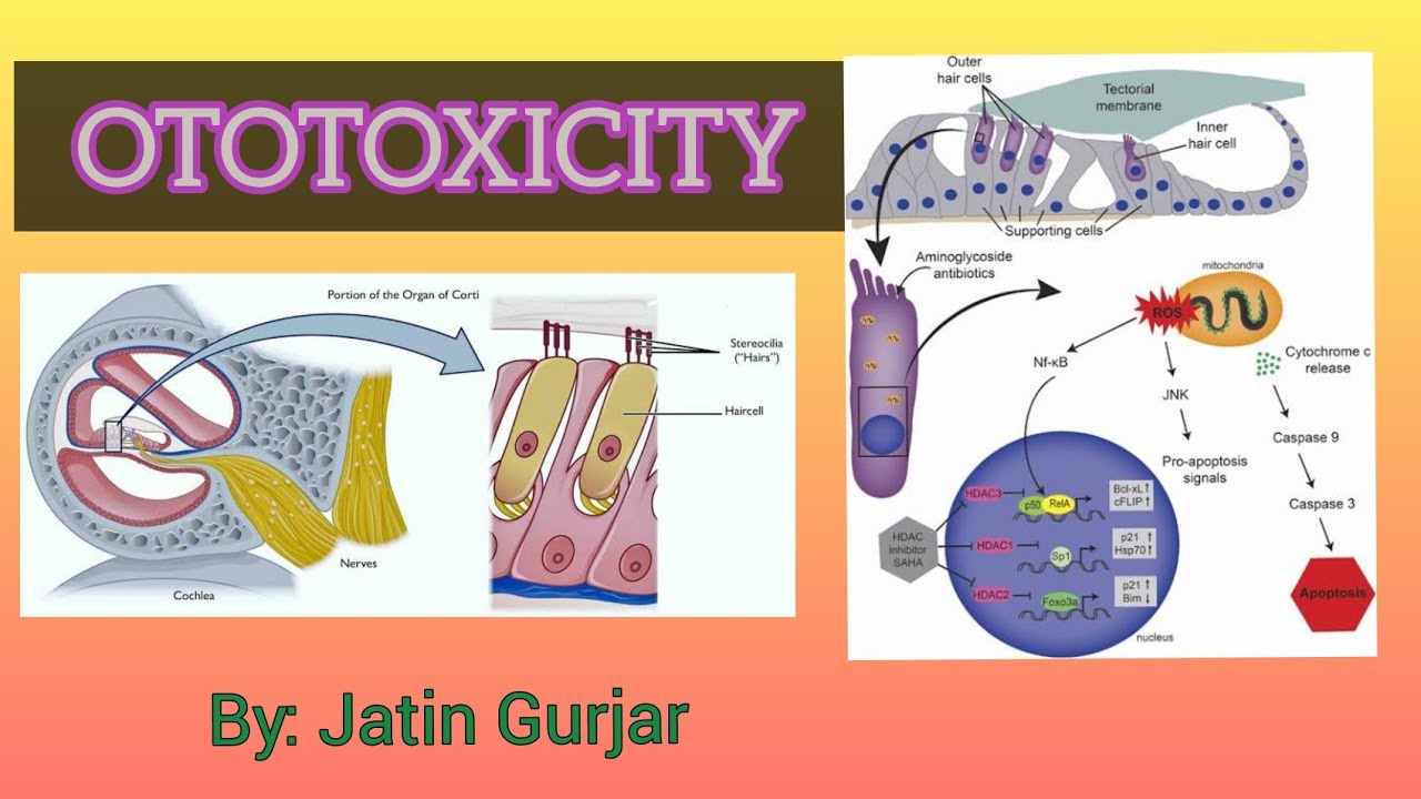 Ototoxicity By JATIN Gurjar - YouTube