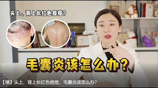 【毛囊炎/痘痘治療】頭上/背上長紅色痘痘，毛囊炎該怎麽辦？皮膚科醫生教你怎麽治療毛囊炎