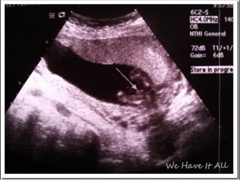 At How Many Weeks Pregnant Can You Find Out a Baby's Gender At How Many Weeks Pregnant Can You Find Out a Baby's Gender