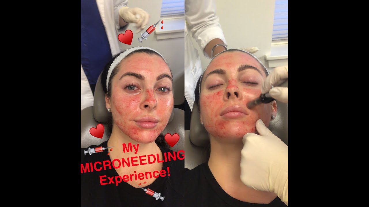 My Microneedling With PRP Experience (Vampire Facial) - YouTube