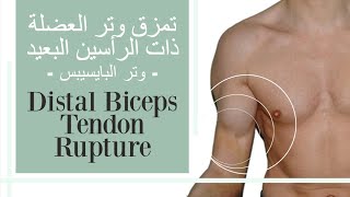 تمزق الوترالبعيد للعضلة ذات الراسين العضدية (البايسيبس) distal biceps tendon rupture