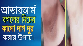 আন্ডার আর্ম/বগলের নিচের কালো দাগ দুর করার কার্যকরী উপায়। How to remove under arm black spot.