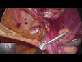 Transabdominal Preperitoneal inguinal hernia repair (TAPP)