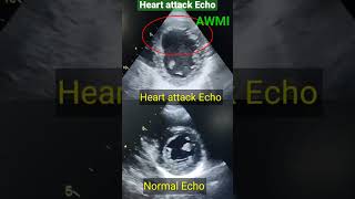 How Echo identify heart attackl एको से हार्ट अटैक का पता कैसे लगता है  #echo #shorts