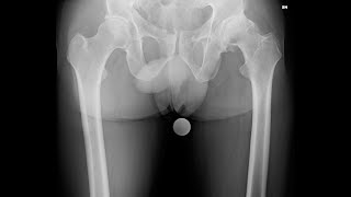 Protesi totale anca per via anteriore diretta Direct Anterior Approach Hip Replacement Surgery