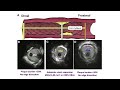 vessel analysis and device sizing wt ivus thrombus dissection u0026 calcium detection by ivus dr a khan