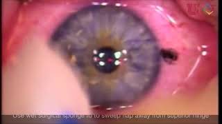 Laser Assisted In Situ Keratomileusis LASIK