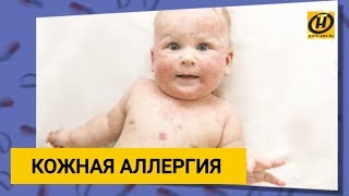 Лечение кожной аллергии у детей