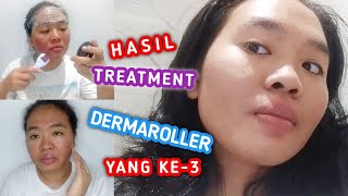 HASIL SETELAH TREATMENT DERMAROLLER KE 3 || MAKIN MEMBAIK