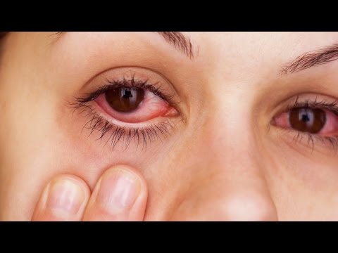 How To Instantly Relieve Itchy/Irritated Allergy Eyes!! How To Instantly Relieve Itchy/Irritated Allergy Eyes!!