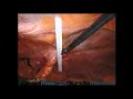 robotic surgarbaker parastomal hernia