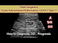 Fetal Cystic Adenomatoid Malformation | CCAM , CPAM | OBS Ultrasound | Fetal Congenital Anomaly Scan