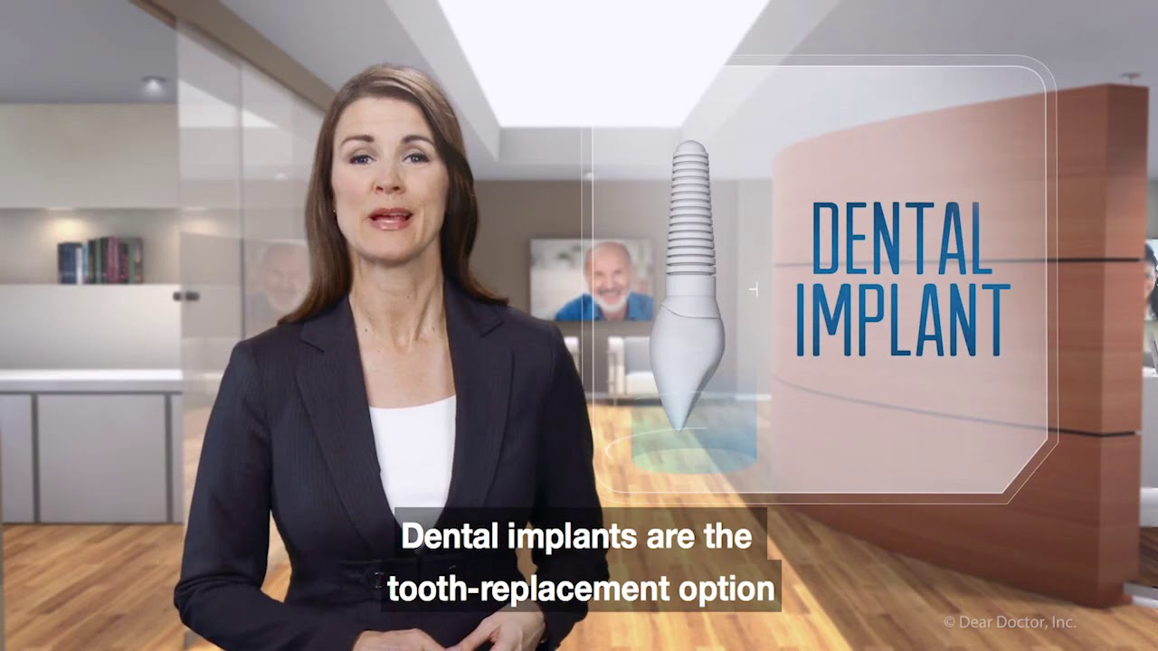 Dental Implants Faqs Youtube