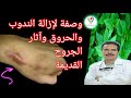 الدكتور جمال الصقلي👈وصفة طبيعية فعالة لإزالة الندوب وآثار الحروق والجروح القديمة والجديدة من الجلد