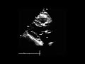 how to measure the left ventricular diameter echocardiography