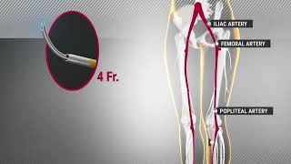 Beback Which Catheter To Use Bentley Innomed Gmbh Mp3 Music & Mp4 video ...