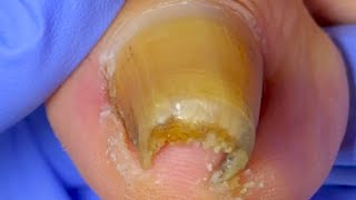 Super Curly Ingrown Toenails Trimmed! Solve Toe Troubles [Doctor Liu Pedicure]