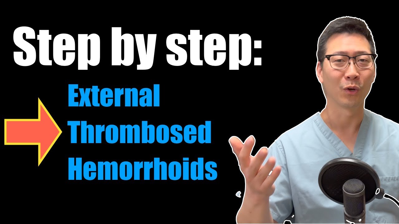 Step By Step Guide: External Thrombosed Hemorrhoids - YouTube