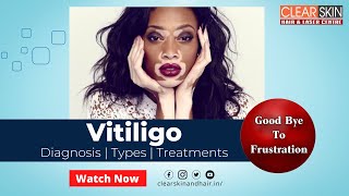 Vitiligo Treatment || Advance Treatment for Vitiligo || Clear Skin in Kurnool || Dr. Kailash