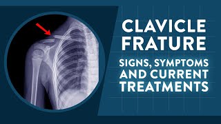 Clavicle fracture: Signs, symptoms and current treatments