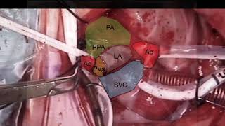 Superior Approach for Correction of Supracardiac Type of Total Anomalous Pulmonary Venous Drainage