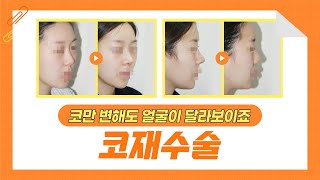 코재수술유명한곳에서 이것만 바꿧다?! | 코라인이 이뻐졌네!! 🤔 | CASE.05 | 메이트성형외과