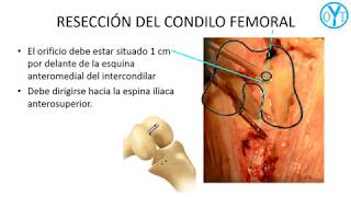 técnica de reemplazo unicompartimental de rodilla con inserto móvil. Resección del condilo femoral