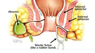 Seton For Complex Fistula