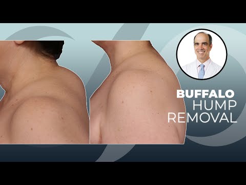 What is a fat pad in neck?