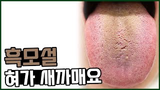 흑모설 원인/ 혀에 까만 백태가 보여요. 혀색깔이 검은색이에요