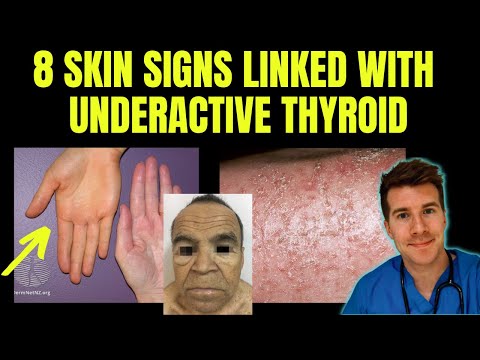 Can you develop hypothyroidism suddenly?