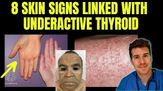 Doctor explains 8 SKIN SIGNS linked with HYPOTHYROIDISM (aka underactive thyroid)