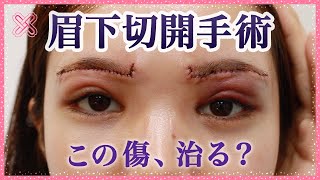 【眉毛下切開】プリモ麻布十番クリニック 施術レポ【上眼瞼リフト】