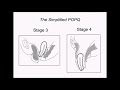 IUGA simplified POP-QPOP