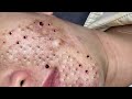 Remove Blackheads and Pimples Popping At HT Spa #30