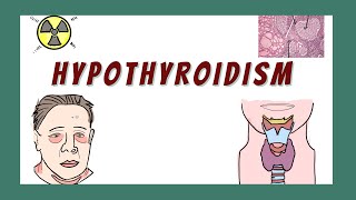 Hypothyroidism and Hashimoto's Thyroiditis - Pathophysiology, causes, Diagnosis, signs & symptoms