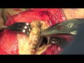 Tibial Tubercle Osteotomy AMZ and MPFL Reconstruction