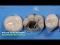 amazing reconstruction of tooth damaged by caries endodontics