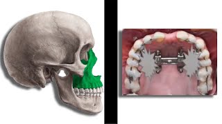 How to Achieve Forward Growth (Maxilla)