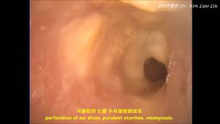 中耳炎 耳膜破洞 耳鳴 聽力障礙 耳黴菌 right COM otorrhea otomycosis perforation of ear drum