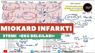 = EKG Tahlili-05 =  Miokard Infarkti =  EKG Namunasi =