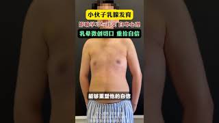 小伙乳腺发育，心理自卑，乳晕微创助力自信 男性乳腺发育症 男性乳腺发育毕晔 雌化胸 抖出健康知识宝藏